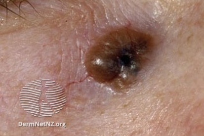 Skin-Cancer-2